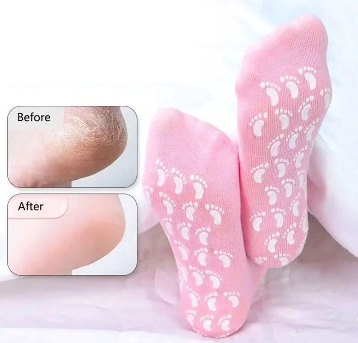 Healing Therapy Gel Socks